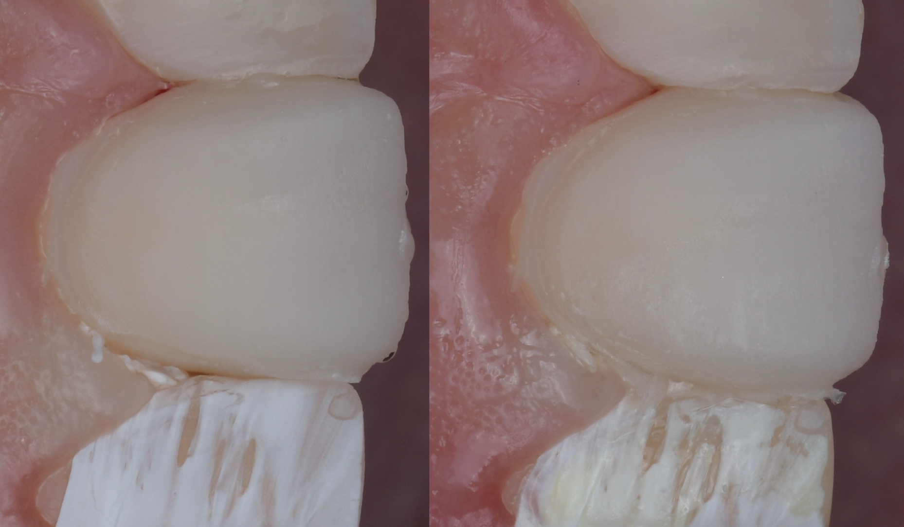 Figure 12: Outcome of the flowable injection procedure.